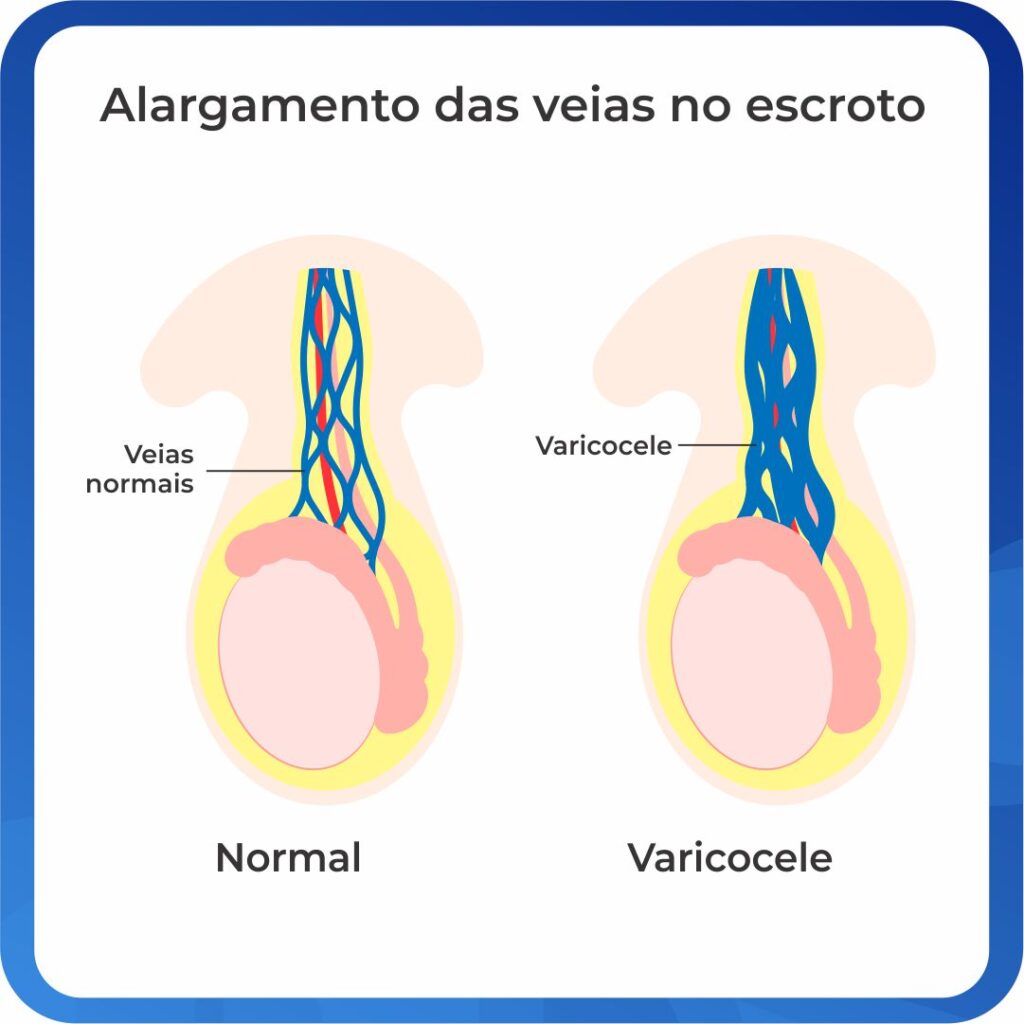 Ilustração de varicocele em comparação com veias normais.